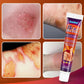 Burn Scald Ointment Burn Scar Removal Pain Relief Antibacterial Cream Repairing Skin Redness Swelling Anti Fungal Health Care