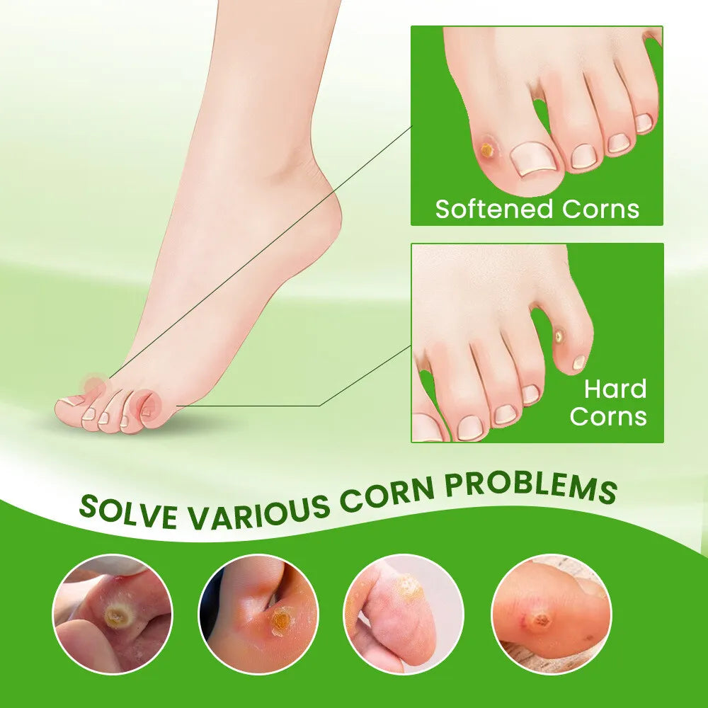 Sumifun Foot Corn Remover Cream Chicken Eye Skin Infection Treatment Ointment Feet Dead Skin Calluses