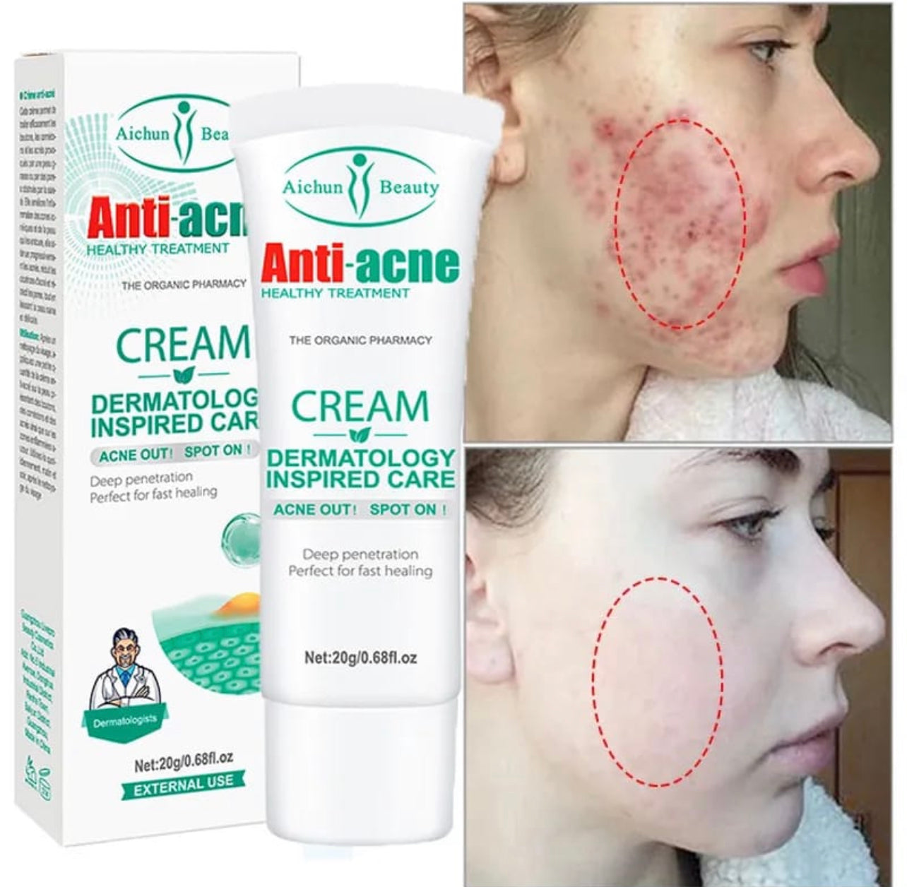 AICHUN BEAUTY | Anti - Acne Cream