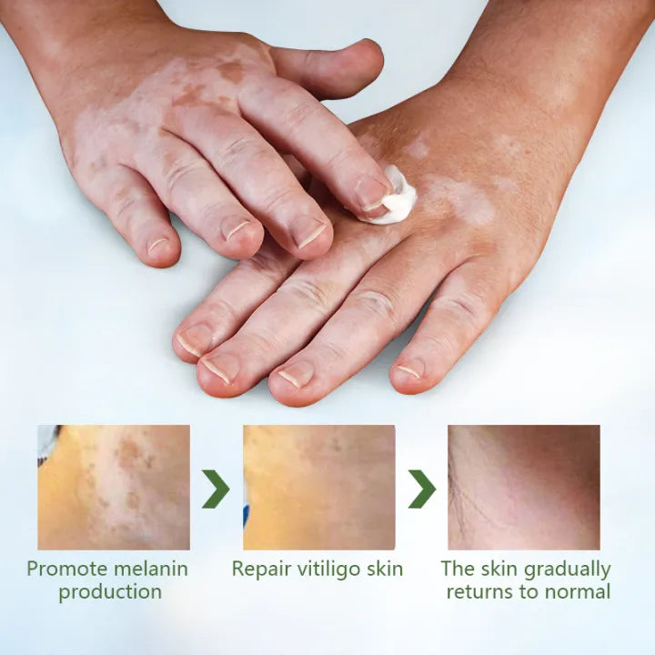 Sumifun Vitiligo Treatment Ointment - Vitiligo Remover & Vitiligo Cream. (20G)