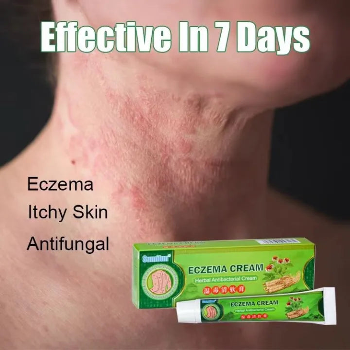 Effective Sumifun Eczema Treatment Cream gamot sa kati kati sa balat buni Psoriasis Treatment Cream Ointment for Itchy Skin