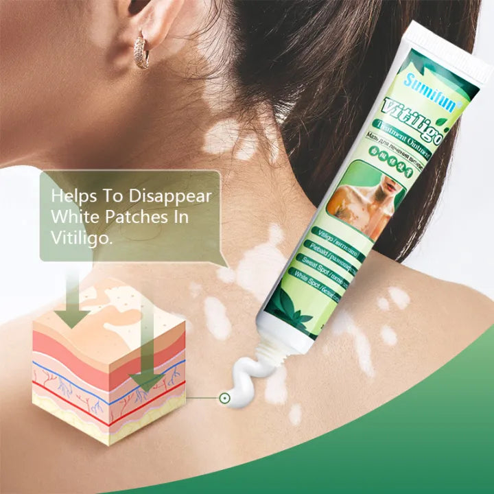 Sumifun Vitiligo Treatment Ointment - Vitiligo Remover & Vitiligo Cream. (20G)