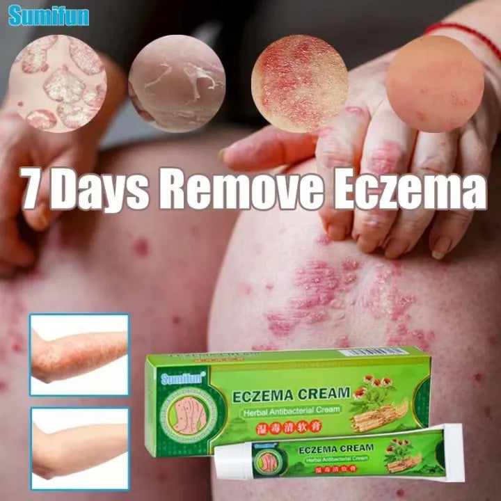 Effective Sumifun Eczema Treatment Cream gamot sa kati kati sa balat buni Psoriasis Treatment Cream Ointment for Itchy Skin